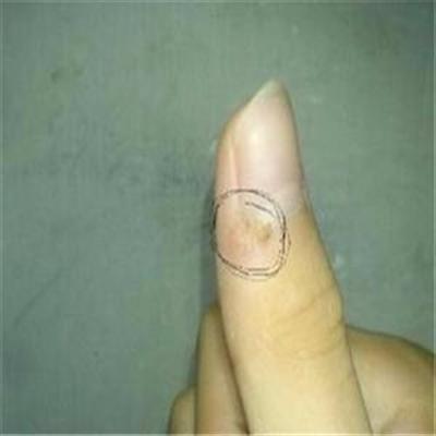 什么是鸡眼？脚底长鸡眼如何去除？